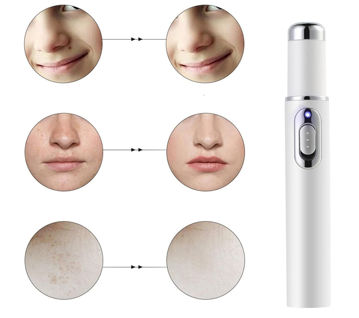 Scar Removal Phototherapy Pen Cream – Asia’s Best-Selling Expert-Recommended Formula for Fading Old Scars & Stretch Marks Naturally