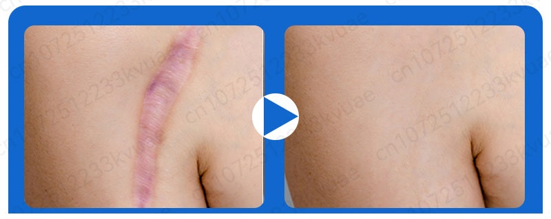 Scar Removal Phototherapy Pen Cream – Asia’s Best-Selling Expert-Recommended Formula for Fading Old Scars & Stretch Marks Naturally
